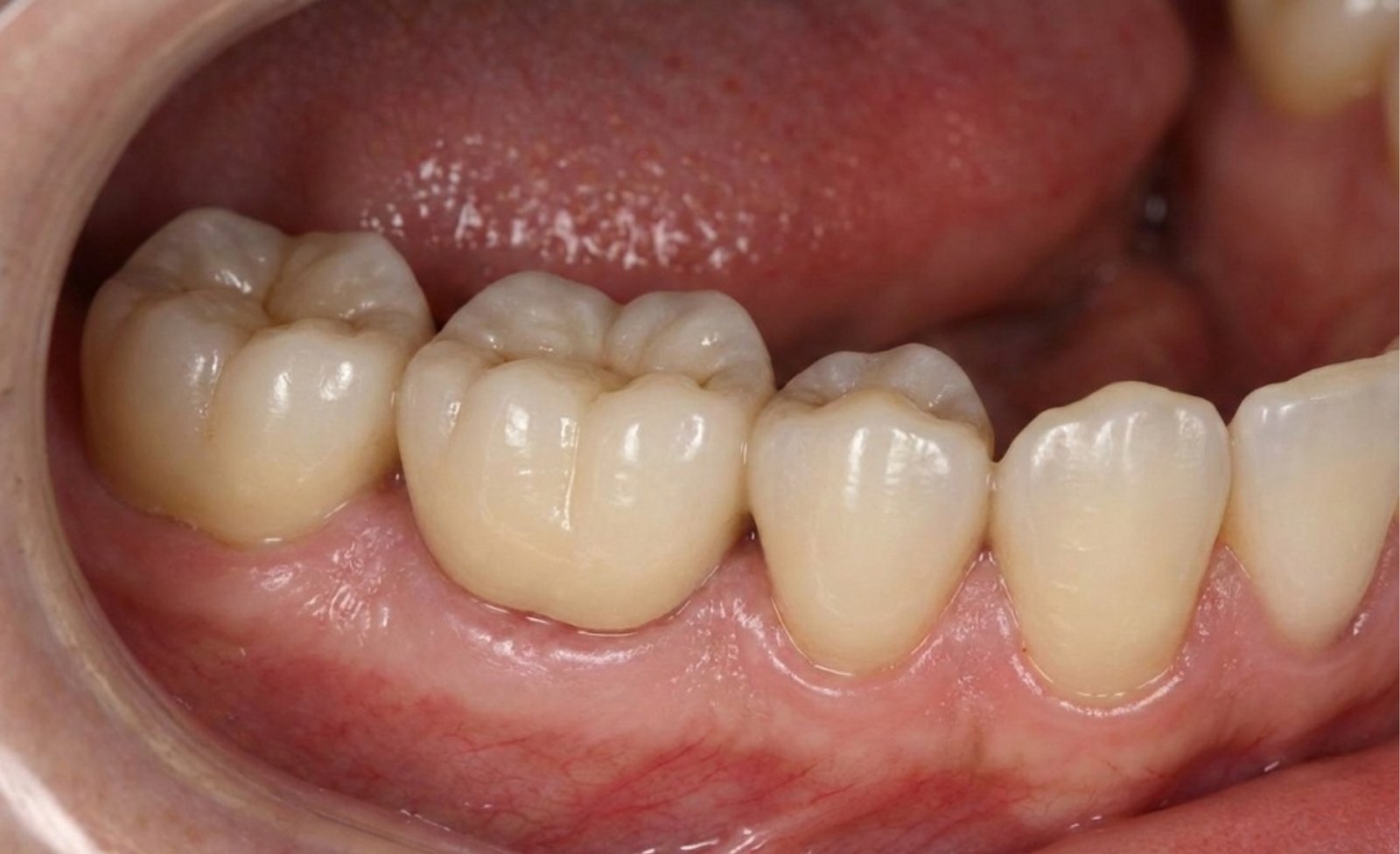 Fixed Dental Prosthesis